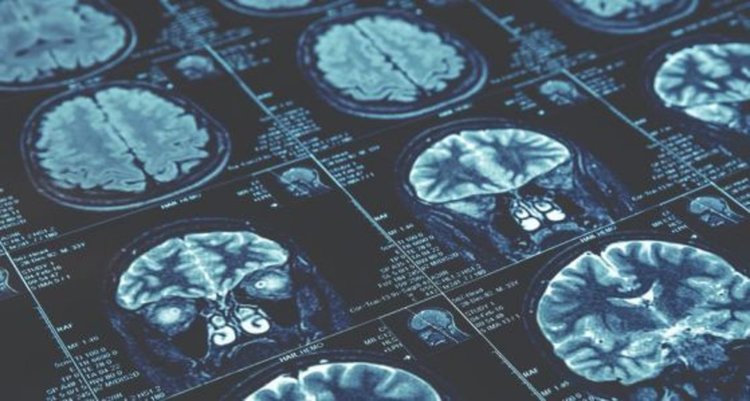 Мозъците на жените са с 3 години по-млади от тези на мъжете